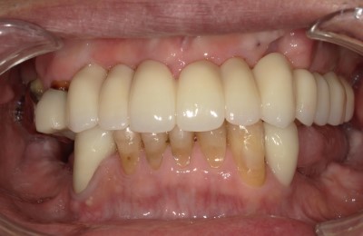 前橋の歯医者まえばしMI歯科のインプラントのアフター画像