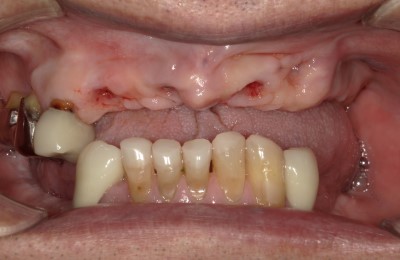 前橋の歯医者まえばしMI歯科のインプラントのビフォー画像
