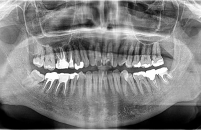 前橋の歯医者まえばしMI歯科の精密根管治療のアフター画像