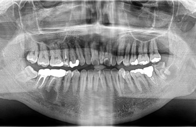 前橋の歯医者まえばしMI歯科の精密根管治療のビフォー画像