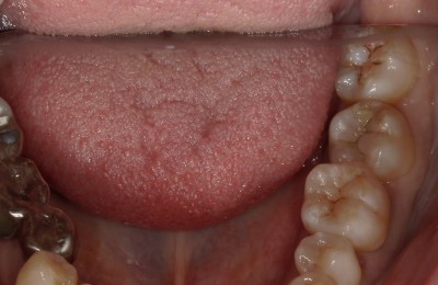 前橋の歯医者まえばしMI歯科のダイレクトボンディングのアフター画像