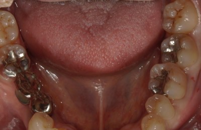 前橋の歯医者まえばしMI歯科のダイレクトボンディングのビフォー画像