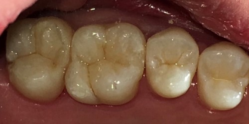 前橋の歯医者まえばしMI歯科では、MI(最小侵襲)を追求しています
