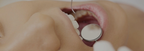 前橋の歯医者まえばしMI歯科の虫歯治療