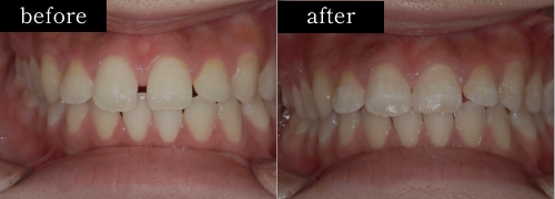 前橋の歯医者まえばしMI歯科のダイレクトボンディング