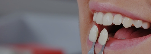 前橋の歯医者まえばしMI歯科のホワイトニング